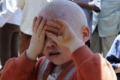 Le président tanzanien promet de protéger les albinos
