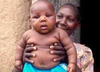 L'obésité infantile progresse à un rythme rapide selon l’OMS